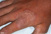 tinea manuum
