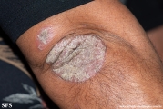 psoriasis