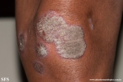 psoriasis