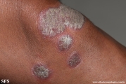 psoriasis