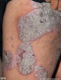 psoriasis