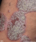 psoriasis