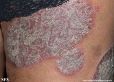 psoriasis