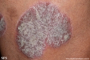 psoriasis