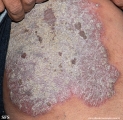 psoriasis