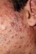 varicella