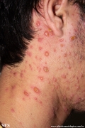 varicella