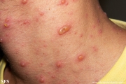 varicella
