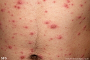 varicella