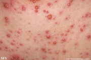 varicella
