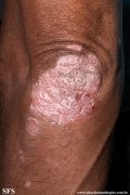 psoriasis