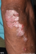 psoriasis