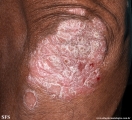 psoriasis