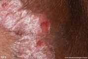 psoriasis