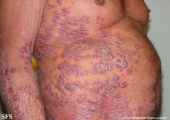 psoriasis