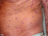 psoriasis