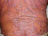 psoriasis