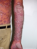 psoriasis
