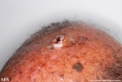 squamous cell carcinoma