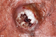 squamous cell carcinoma