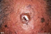 squamous cell carcinoma