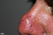 lymphocytoma cutis