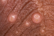 molluscum contagiosum