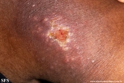 sporotrichosis
