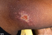 sporotrichosis