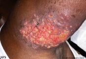 sporotrichosis