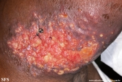 sporotrichosis