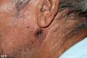 squamous cell carcinoma