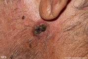 squamous cell carcinoma
