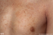 pityriasis versicolor