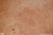 pityriasis versicolor