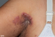 hailey-hailey disease