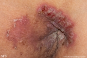 hailey-hailey disease