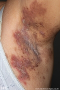 hailey-hailey disease