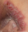 hailey-hailey disease