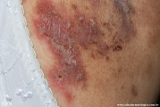 hailey-hailey disease