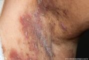 hailey-hailey disease