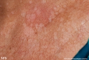 pityriasis versicolor