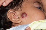 haemangioma