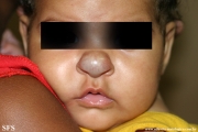 haemangioma