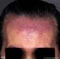secondary_cutaneos_b-cell_lymphoma