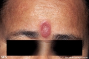 facial_granuloma