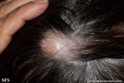 trichilemmal cyst