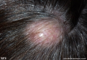 trichilemmal cyst