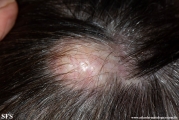 trichilemmal cyst