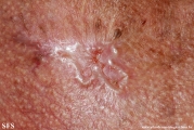 basal cell carcinoma